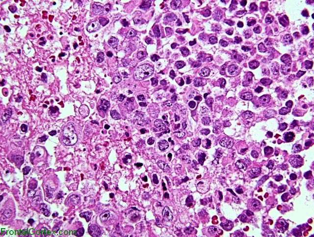 Atypical teratoid/rhabdoid tumor, H&E stain x 400